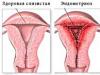 Эндометриоз тела матки — что это такое доступным языком и что нужно знать о данной патологии