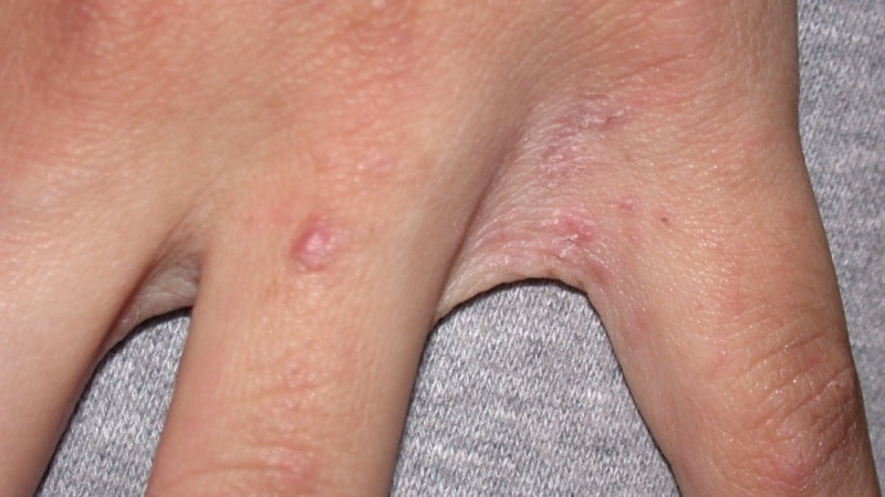 Transfer of scabies from person to person