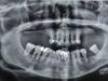 Какие анализы необходимо сдать перед имплантацией зубов