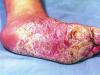 How is mycosis of the foot in intertriginous form treated?