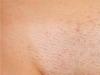 Pimples on the pubis in men: photos, causes, removal