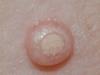 Molluscum contagiosum on the skin in children: photos and causes of pathology, treatment at the initial stage and removal Molluscum contagiosum is increasing