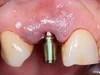 Tests before dental implantation