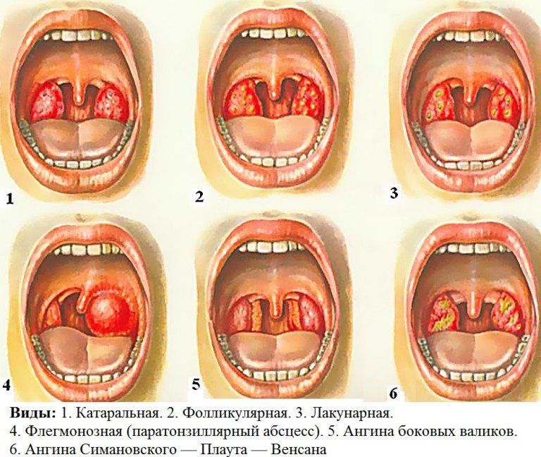 Chronic tonsillitis. Tonsillitis. Causes, symptoms, signs, diagnosis and treatment of pathology Tonsillitis form