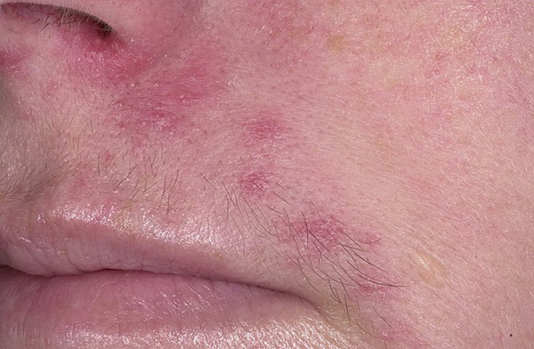 Treatment of rosacea with folk remedies proven