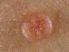 Molluscum on the skin of a child: causes and treatment Molluscum contagiosum on the abdomen