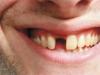 Dental implants: harm and benefit, contraindications for their installation, reviews Contraindications for dental implantation