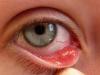 What to do if you have a stye on your eye